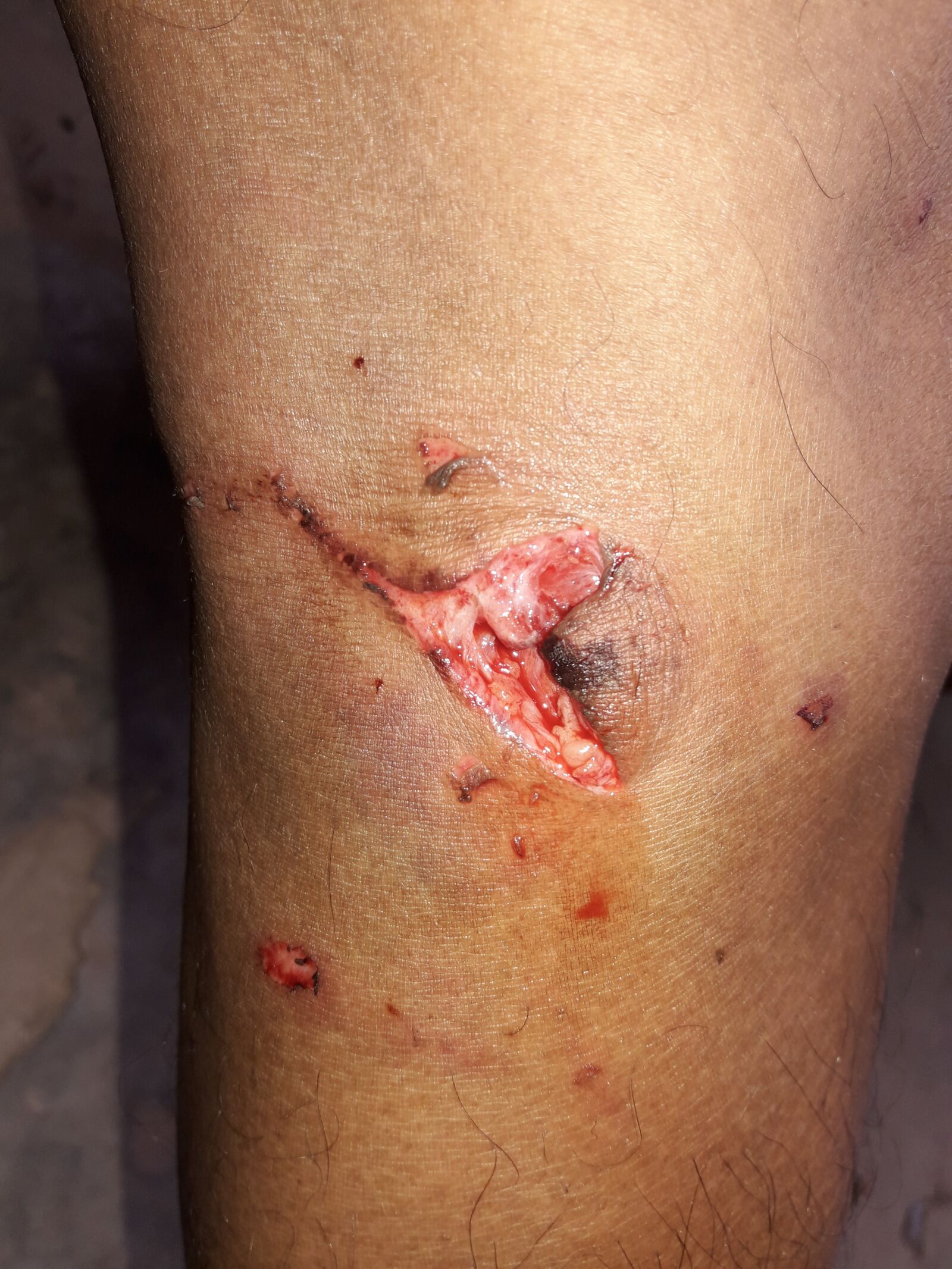 Samsung Galaxy J7 Neo sample photo. Dog bite, wound, blood photography