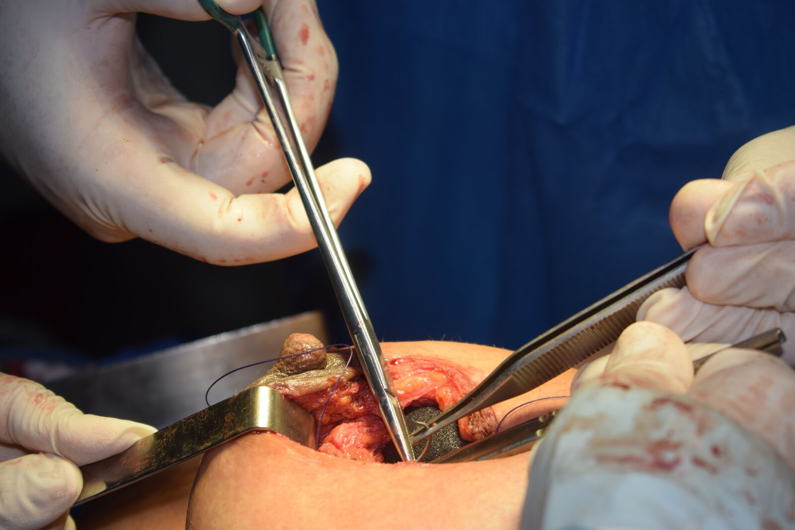 Nikon D3300 sample photo. Mammoplasty, plastic surgery, medical photography