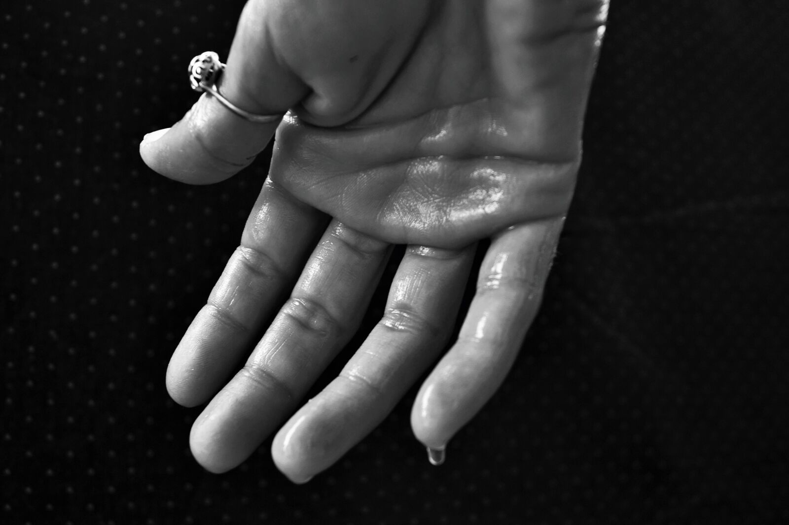 Sony DT 18-55mm F3.5-5.6 SAM II sample photo. Hand, hyperhidrosis, sweating photography
