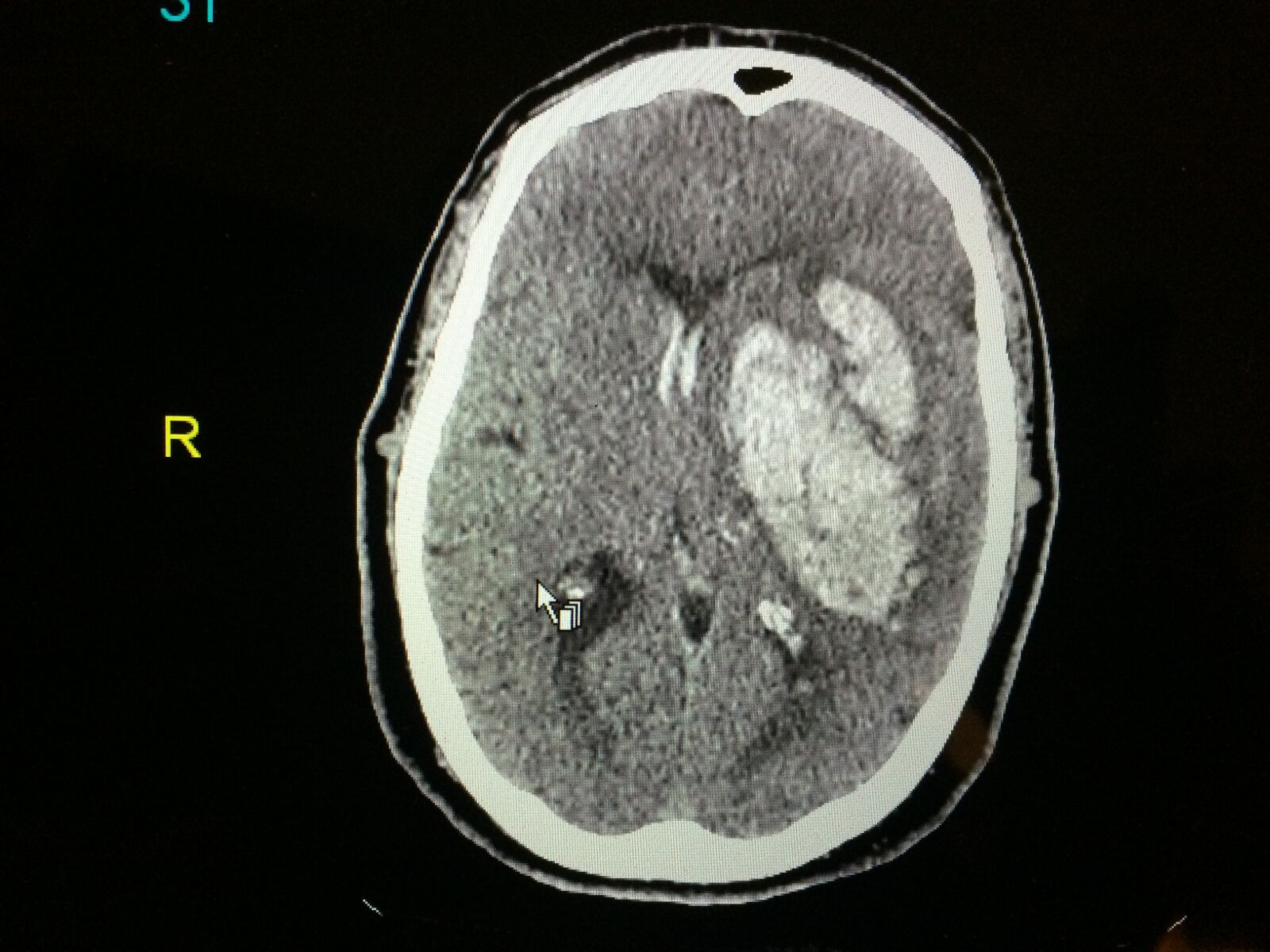 iPhone 5s back camera 4.15mm f/2.2 sample photo. Hemorrhagic stroke, brain bleed photography