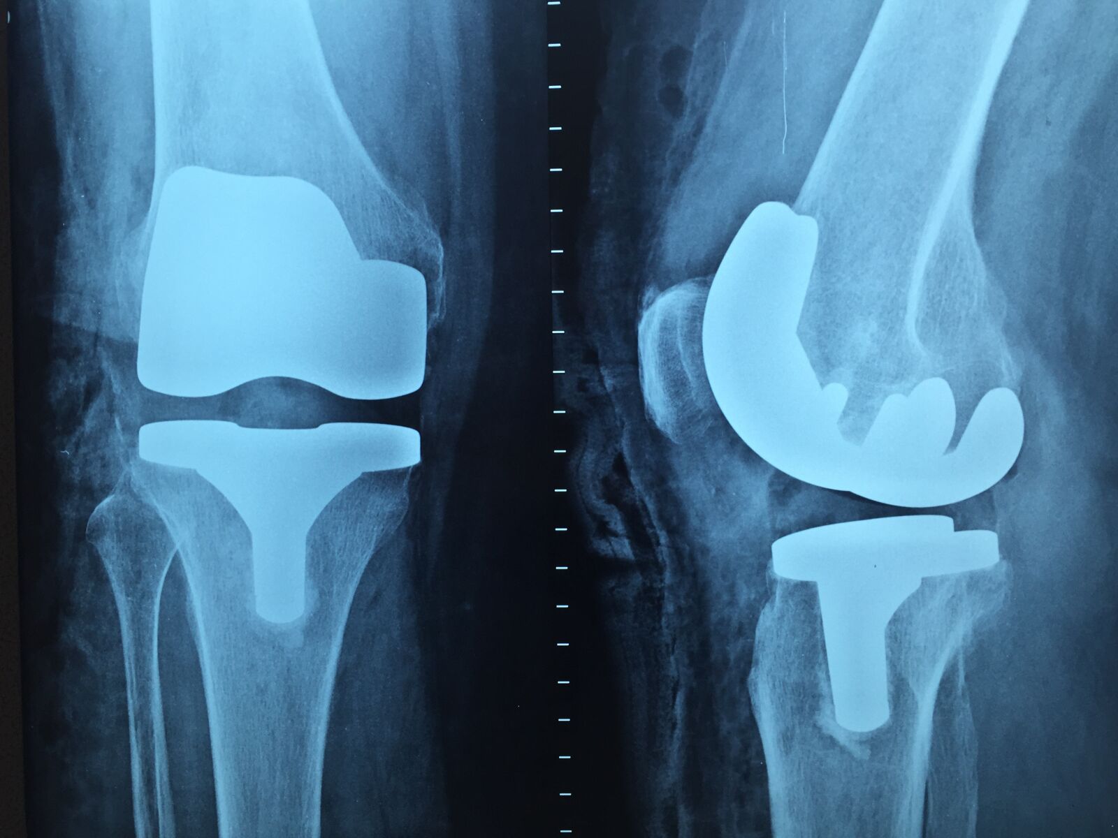 Apple iPhone 6 sample photo. Doctor, orthopedics, x-ray photography